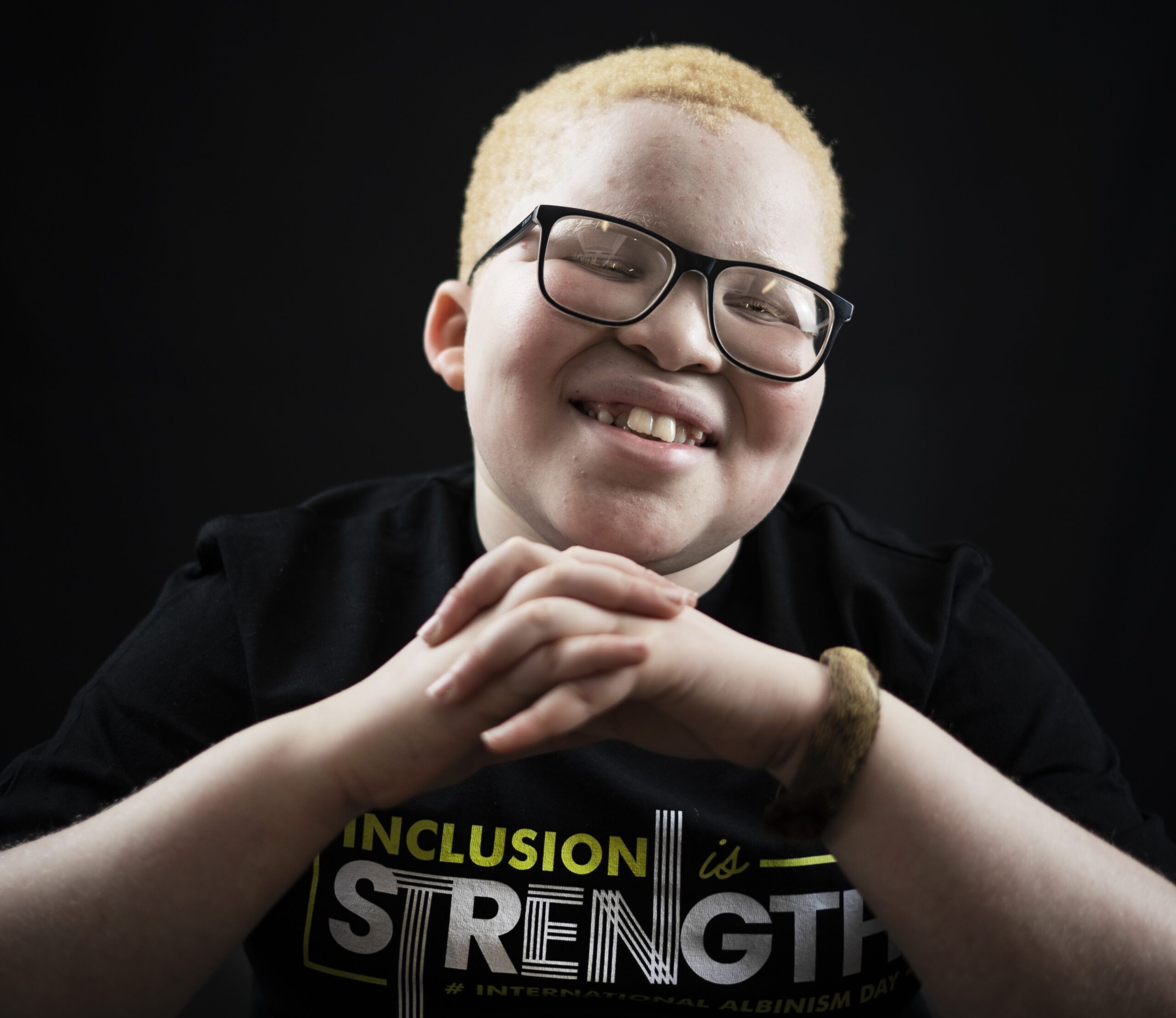 Photo of a pre-teen grinnning at the camera. He has albinism, and is wearing specs, with his hands clasped in front of him. 